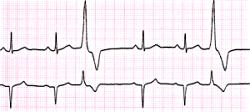 ekg